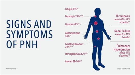 Paroxysmal Nocturnal Hemoglobinuria - Symptoms & Causes