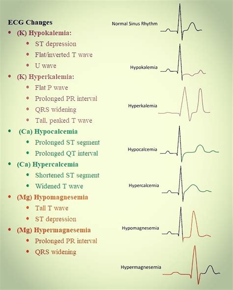 Hypomagnesemia Ecg