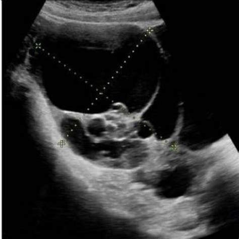 Right ovarian mass with multiloculated cyst and solid gelatinous ...