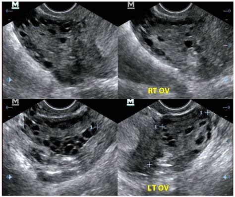 Normal Ovary Transvaginal Ultrasound