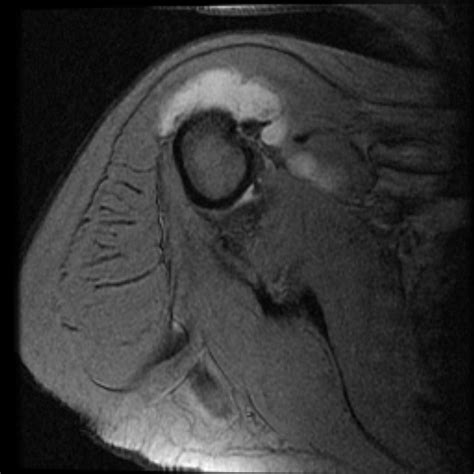 Shoulder Bursitis Radiology