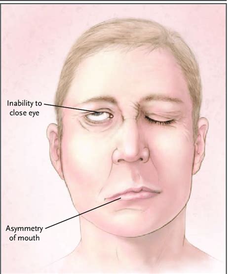 Bell's Palsy : Bell S Palsy Facial Nerve Problems Treatment Causes ...