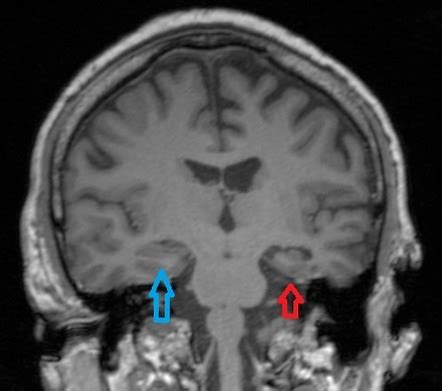 44+ Temporal Lobe Axial Mri Brain Anatomy