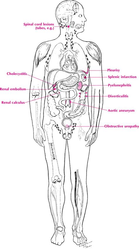 Flank Pain - Differential Diagnosis in Primary Care, 4th Edition