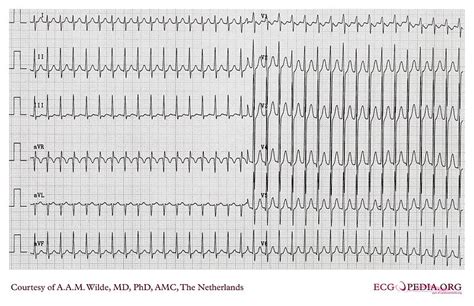 Hypoglycemia electrocardiogram - wikidoc