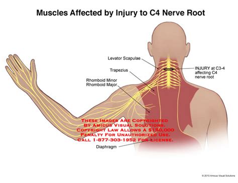 Muscles Affected by Injury to C4 Nerve Root