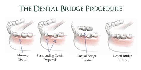 Bridge Procedure | Ridgeview Family Dental