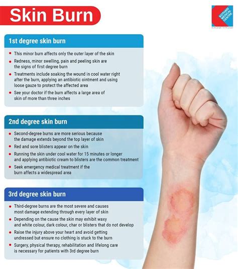 Degrees of Skin Burns | Skin burns, Burns treatment, Burn care nursing