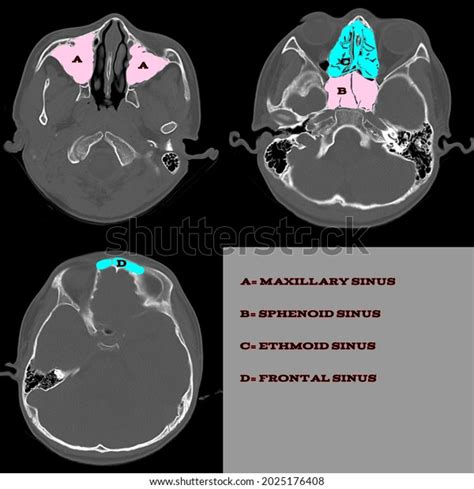 Anatomy Paranasal Sinuses Ct Scan Vector Stock Vector (Royalty Free ...