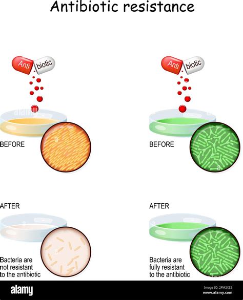 Antibiotic resistance. Experiment with two Petri dish, and bacteria. comparison colonies of ...