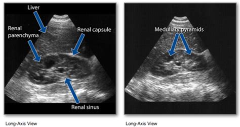 Renal Pyramids Ultrasound