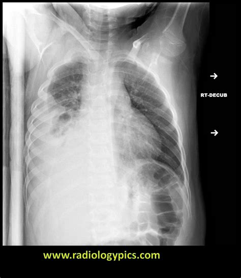 Solution to Unknown Case #23 – Empyema (loculated pleural effusion) | RADIOLOGYPICS.COM