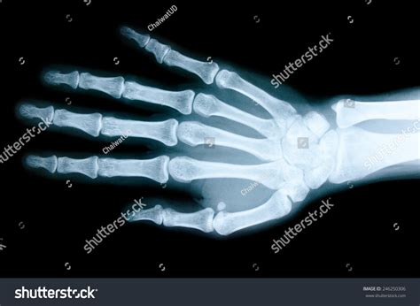 4,448 Roentgen in hand Images, Stock Photos & Vectors | Shutterstock