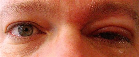 Shingles In The Eye: Symptoms, Causes and Treatments