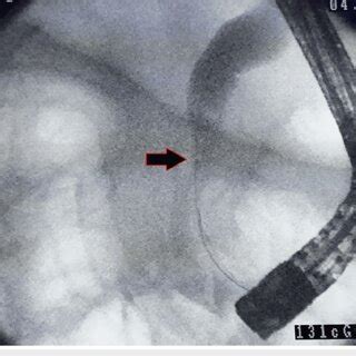 Endoscopic retrograde cholangiopancreatography image demonstrating a ...