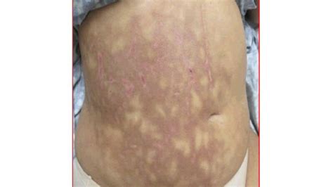 Mottled Skin (Livedo Reticularis): Causes, Signs, and Treatment