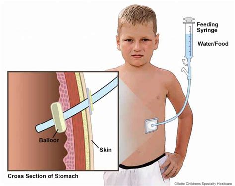 Managing and caring for enteral feeding tubes - Actionable Intelligence