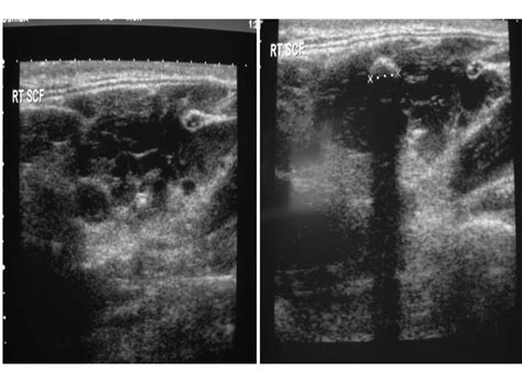 Venous Malformation Ultrasound