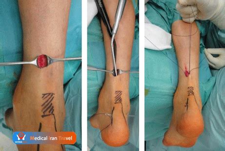 Achilles Tendon Surgery in Iran | Procedure,Risk,Result,Cost | MITRAMED