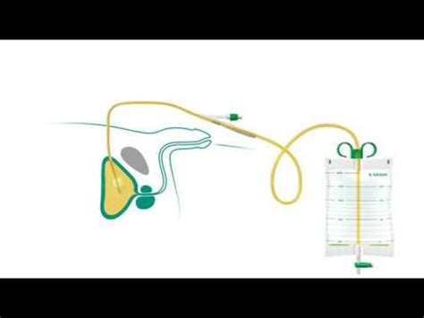 Suprapubic Catheter: How to use - YouTube