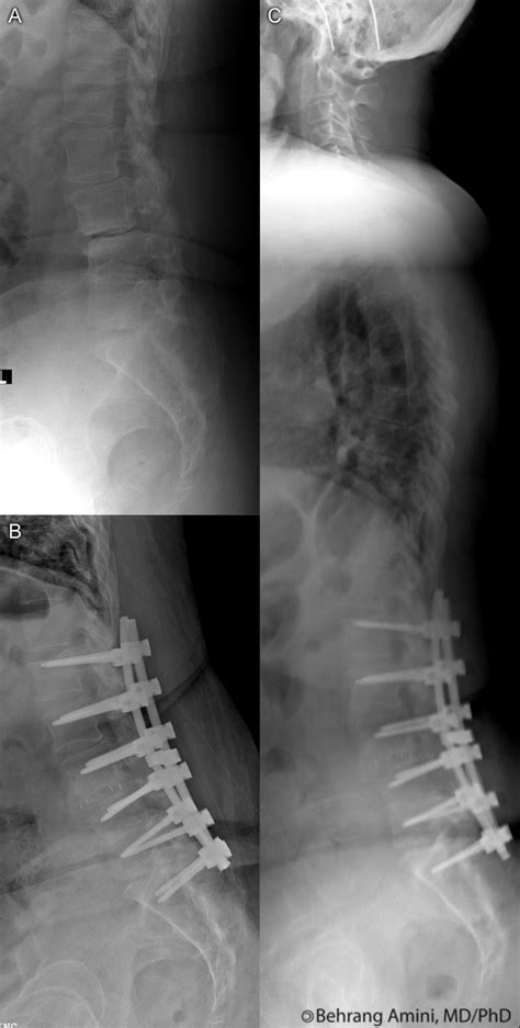 Roentgen Ray Reader: Sagittal Balance and the Flat Back Syndrome