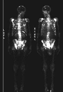 Imaging in Prostate Carcinoma 5- Nuclear Imaging ~ Urology Notes 2012