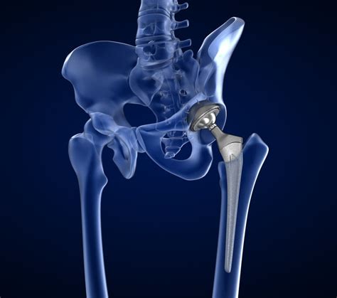 Hip Replacements - Riley Physiotherapists