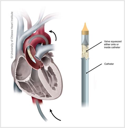 TAVI - Ottawa Heart Institute