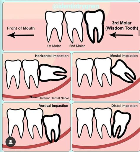 Coronectomy - Dentist Kingston