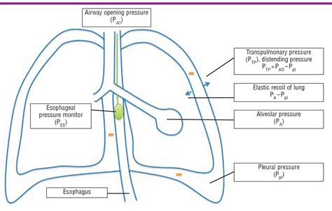 Figure 1 from Esophageal Pressure Measurements in Patients With Acute Respiratory Distress ...