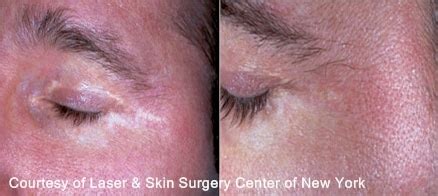 Hypopigmentation Skin Overview New York, NY | Laser Center