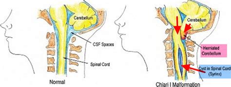 Chiari Malformation - Causes, Symptoms, Prognosis, Diagnosis, Treatment