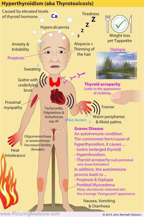 Thyroid Troubles: Hyperthyroidism and Thyrotoxicosis - Manual of Medicine