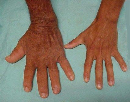 Acromegaly Symptoms • What Are the Symptoms of Acromegaly?