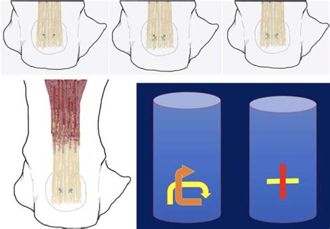 Retrocalcaneal Enthesophyte Resection With Functional Lengthening of the Achilles Tendon and ...