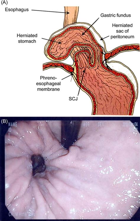 Figure 4 from Massive hiatal hernia: a review. | Semantic Scholar