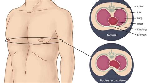 What is Pectus Excavatum?