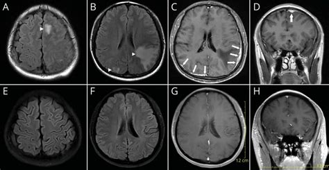 Figure Neuroimaging (MRI) During the Course of the Disease | Download ...