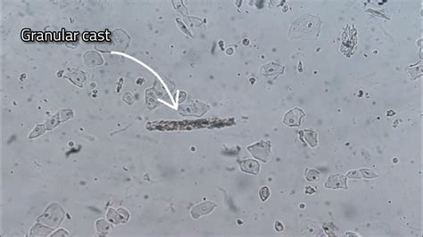 Urine analysis (granular cast & transitional epithelial cells) - YouTube