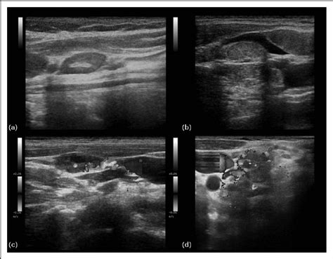 Lymphoma Neck Ultrasound