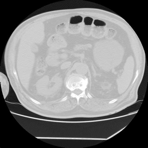 Atoll sign (Radiopaedia 82033-96035 Axial lung window) - NC Commons