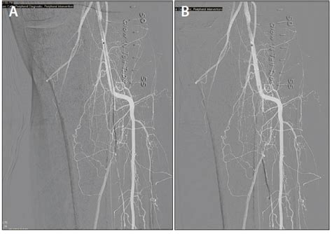 Endovascular Today - Multiple Lower Limb Occlusions and Vascular ...