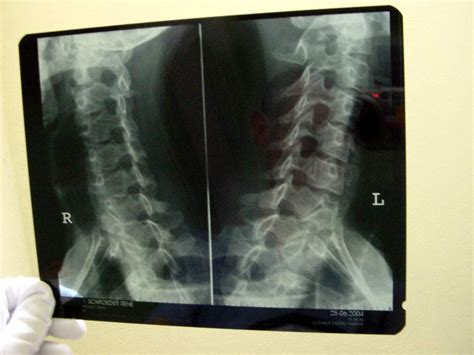 Cervical Spondylosis