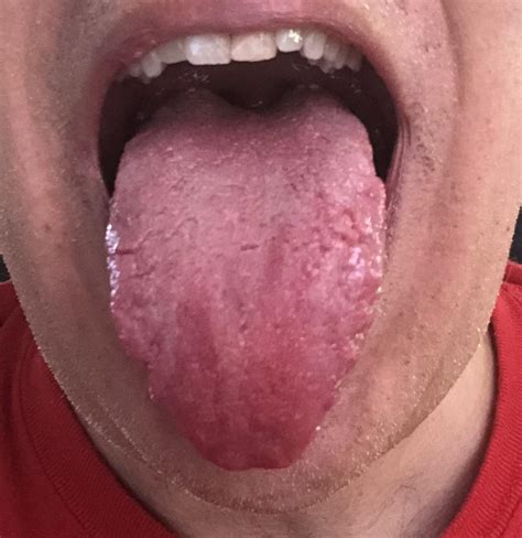 Tongue is changing color : r/denistry