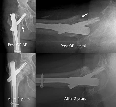 Hook leverage technique for reduction of intertrochanteric fracture ...