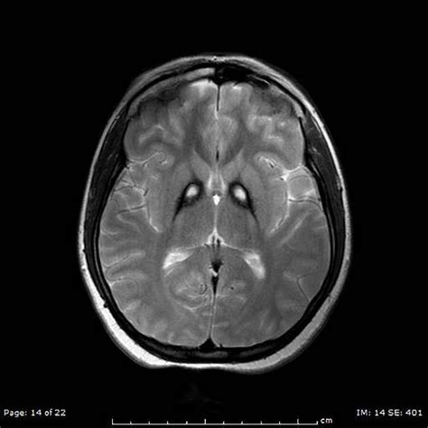 Gliosis Mri - IMobile Cool