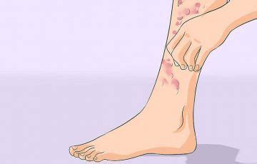 Cellulitis stages: Rash, Pain, Itchy, Sepsis and Recurrent - Skin Diseases