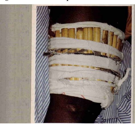 Figure 1 from Review of the practice of traditional bone setting in Nigeria. | Semantic Scholar