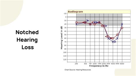 How to Read an Audiogram | Dr. Amy Sarow Explains