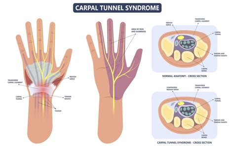 Carpal tunnel syndrome – What it is and what are the treatment options ...